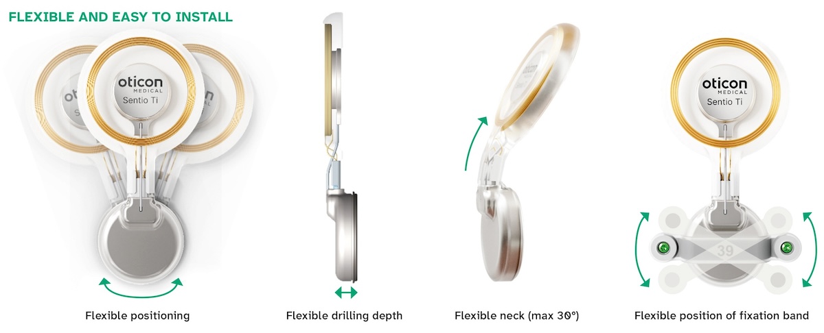 An innovative option: Oticon Medical's Sentio System transcutaneous ...