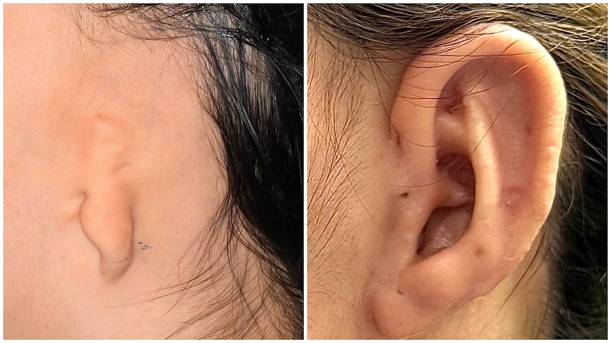 World first nerve freezing technique reduces pain after ear reconstruction
